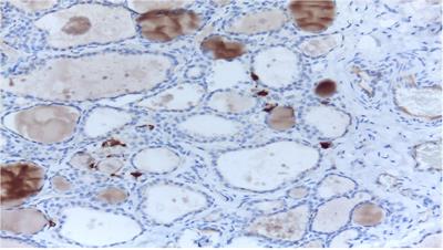 Critically evaluated key points on hereditary medullary thyroid carcinoma